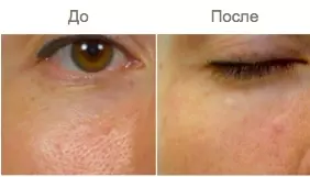 Биоревитализация Биоревитализация