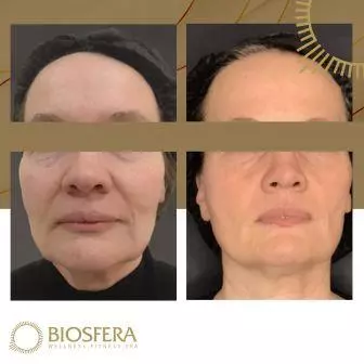 3D-лифтинг