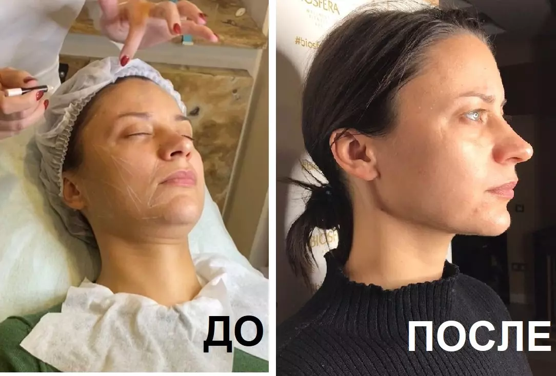 Плазмотерапия