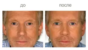 Ботулинотерапия (Ксеомин, Диспорт, Релатокс) Ботулинотерапия (Ксеомин, Диспорт, Релатокс)