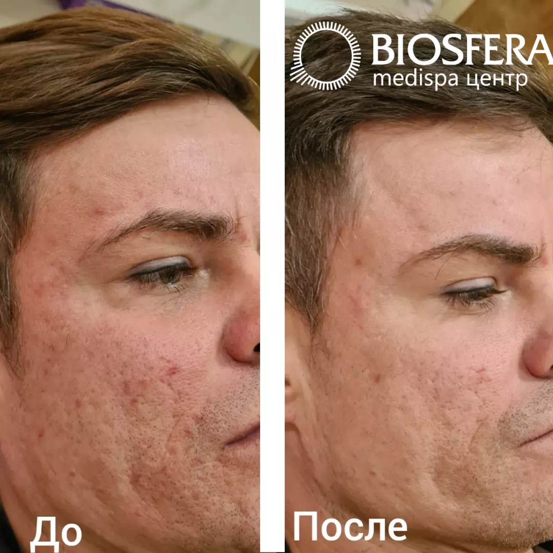 Удаление постакне на аппарате М22