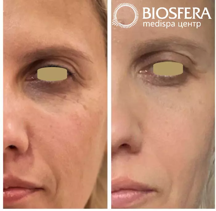 Микроигольчатый RF-лифтинг на аппарате INFINI - врач-косметолог mediSPA BIOSFERA Эльвира Микроигольчатый RF-лифтинг на аппарате INFINI - врач-косметолог mediSPA BIOSFERA Эльвира