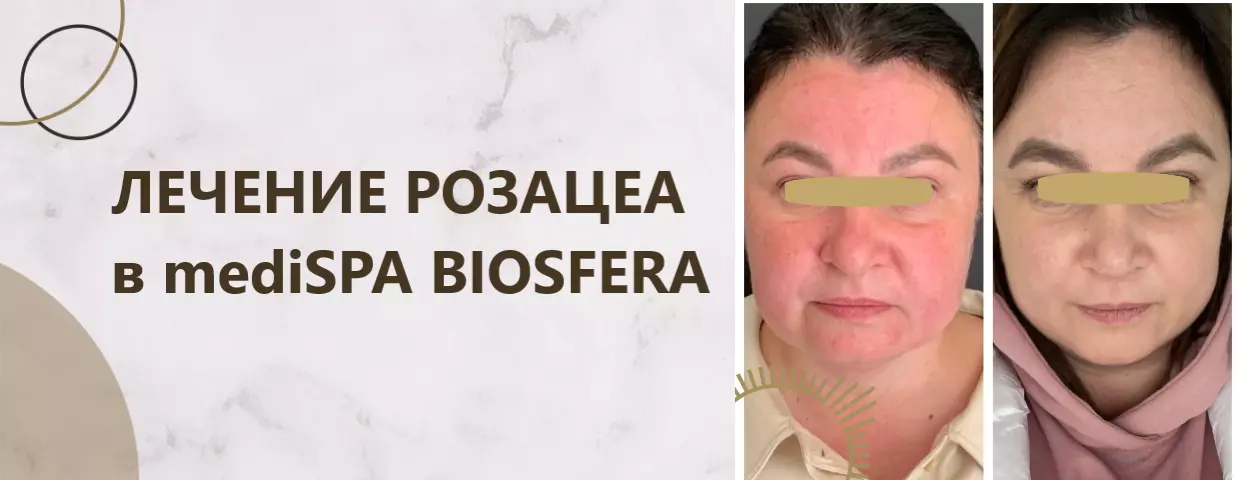 Лечение розацеа Лечение розацеа
